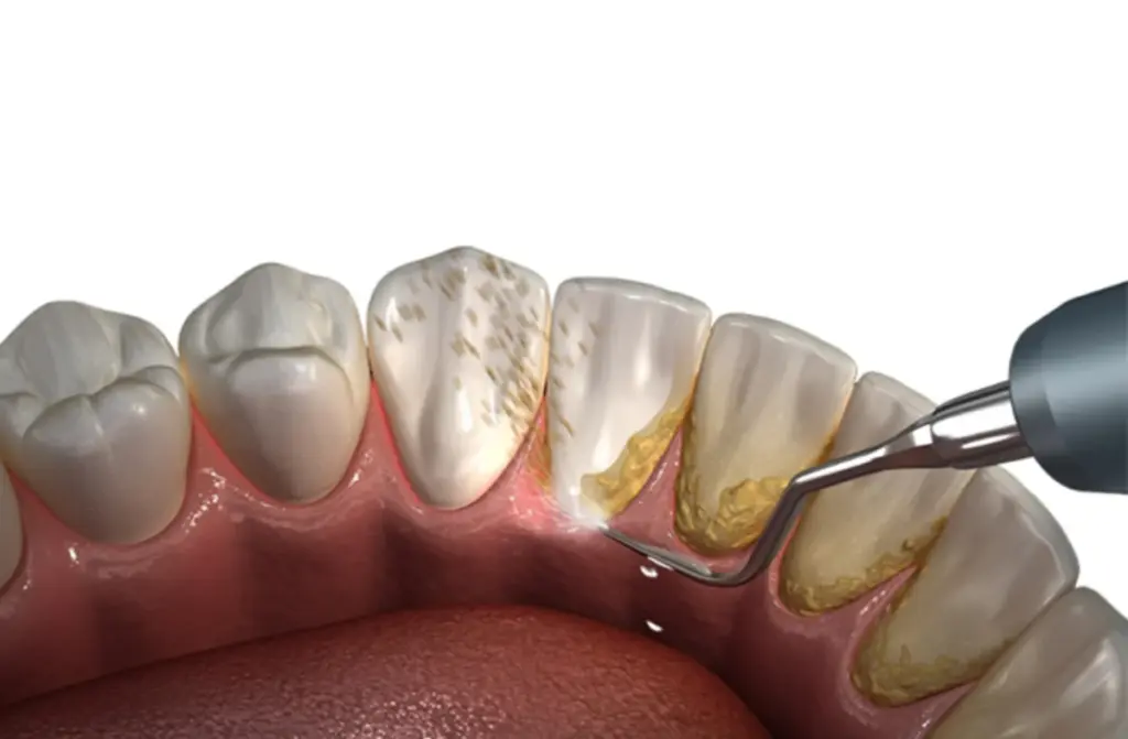 Teeth cleaning