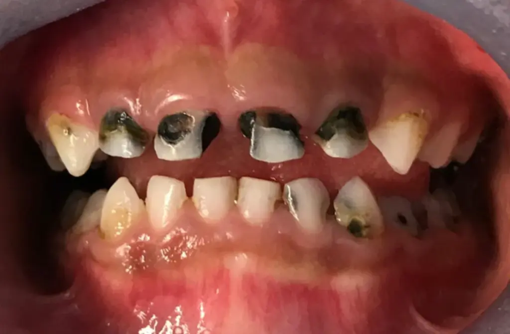 Baby teeth series