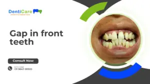 Gap in front teeth