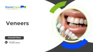 Veneers