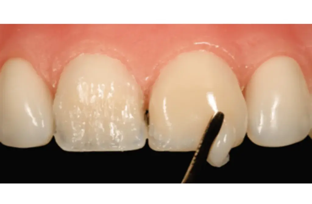 Veneers
