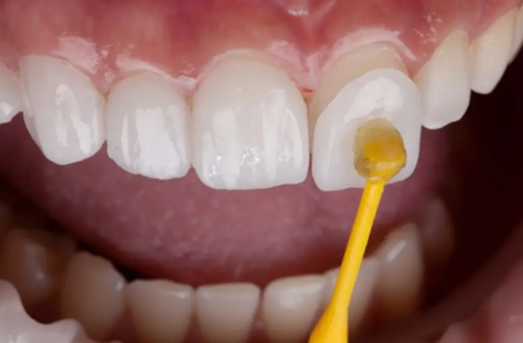 Veneers
