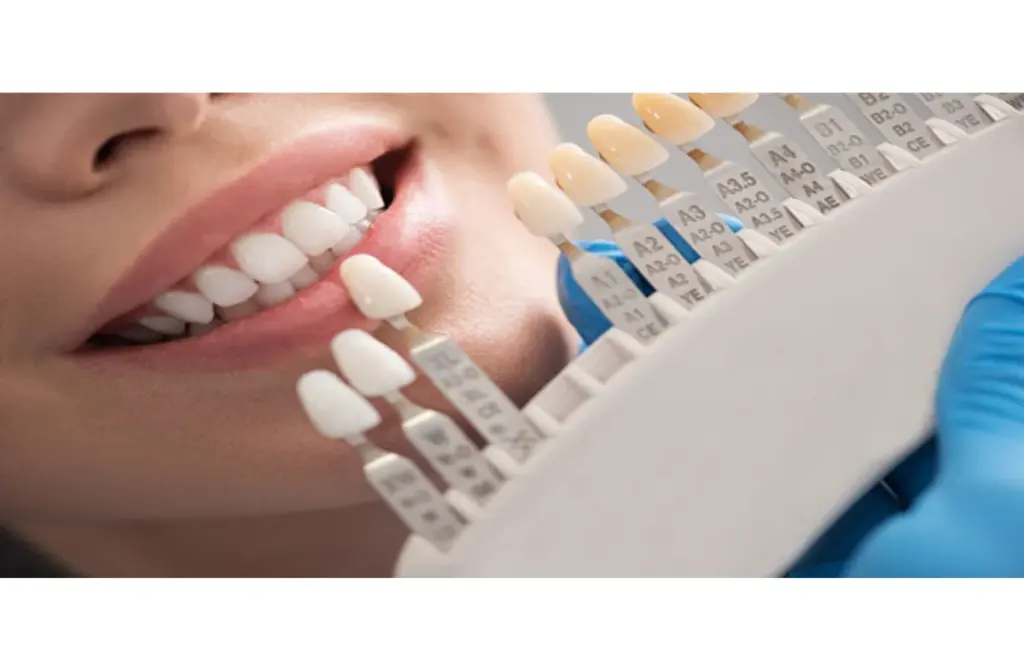 Veneers