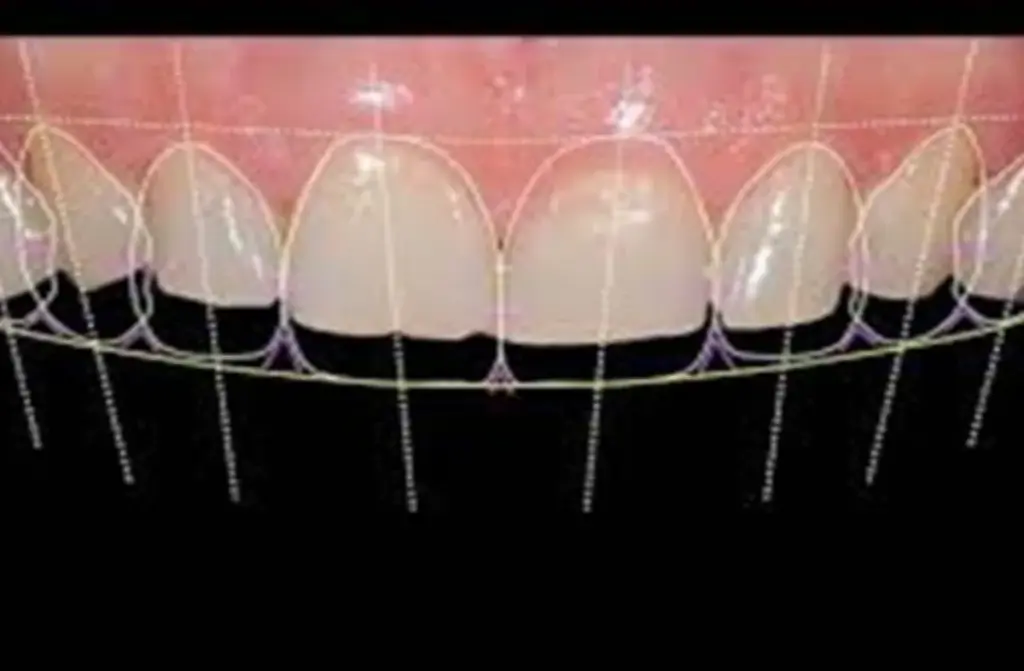 Veneers