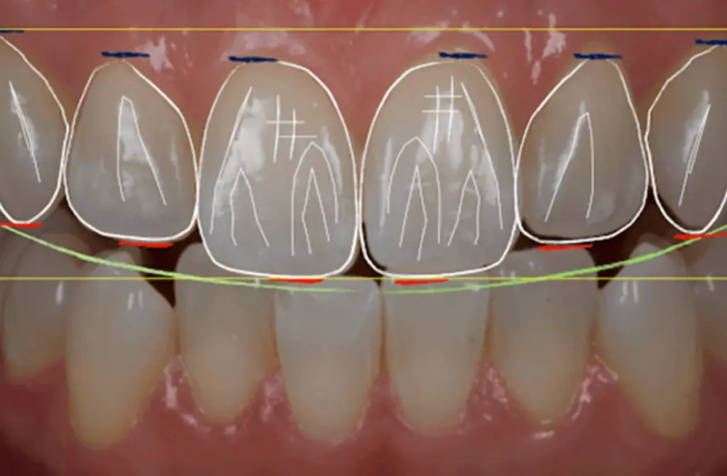 Veneers