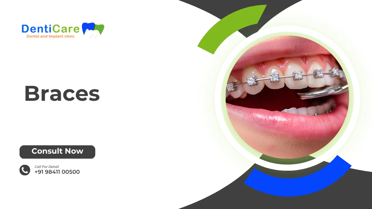 Braces