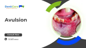 Chapter 17- Avulsion