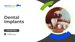 Chapter 16 - Dental Implants ( Part C)
