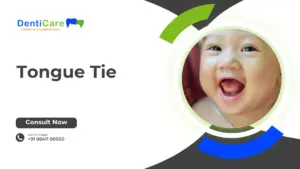 Tongue Tie