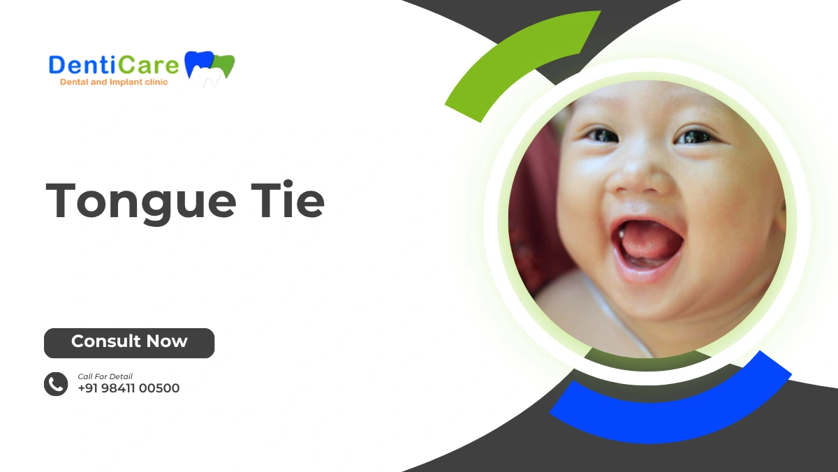 Tongue Tie