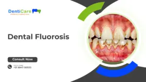 Dental Fluorosis