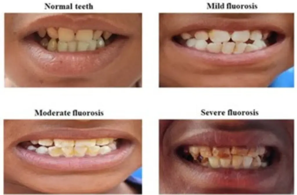 Dental Fluorosis