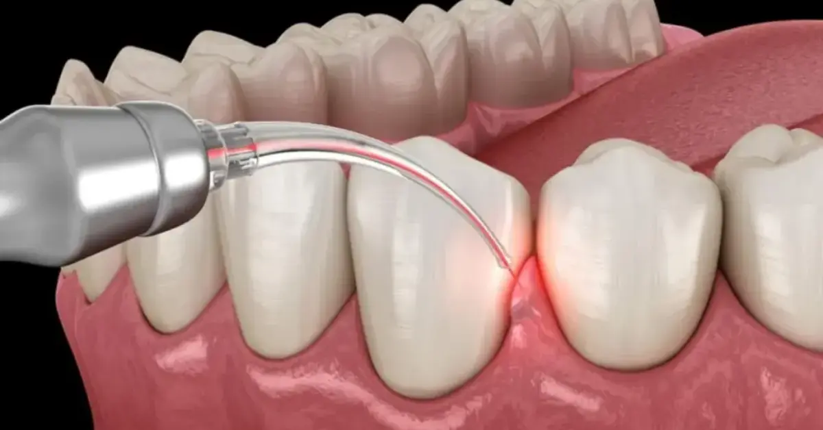 Advanced Periodontics - LANAP