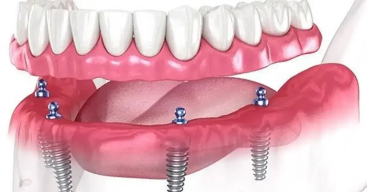 All on 4/ 6 Implants