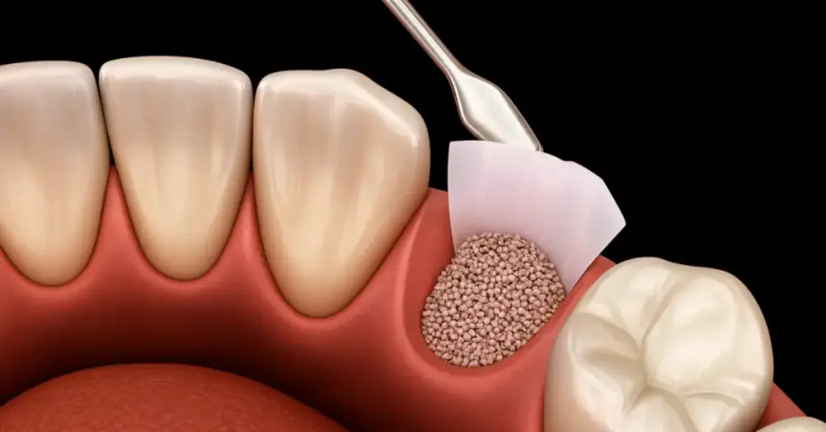 Bone Grafting