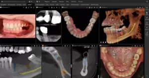 CBCT GUIDED IMPLANT PLANNING