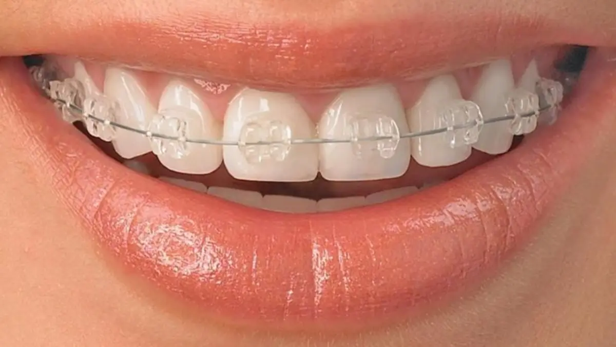 Ceramic Brace