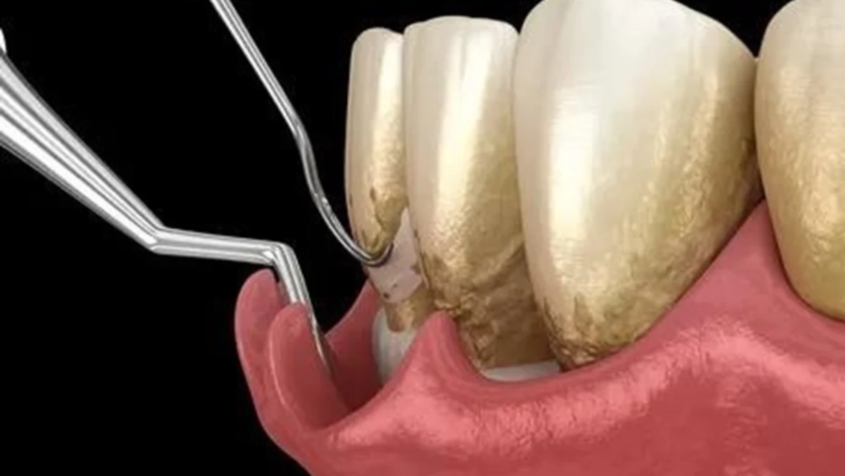 SUB GINGIVAL CURETTAGE