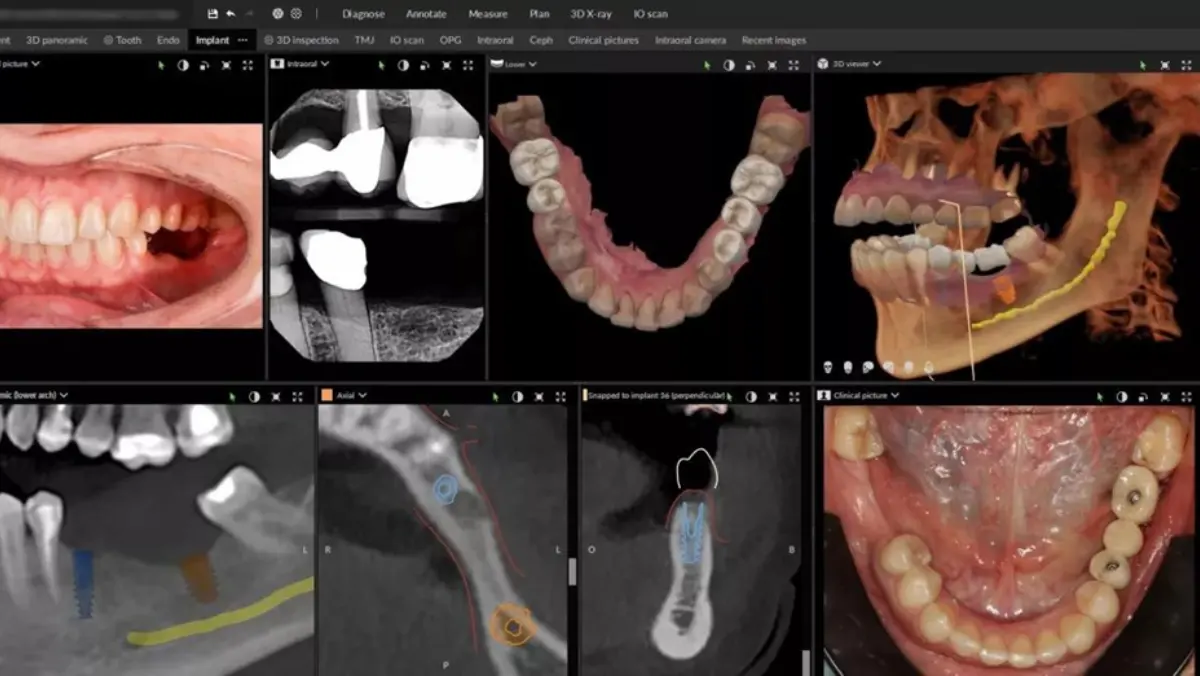 CBCT GUIDED IMPLANT PLANNING