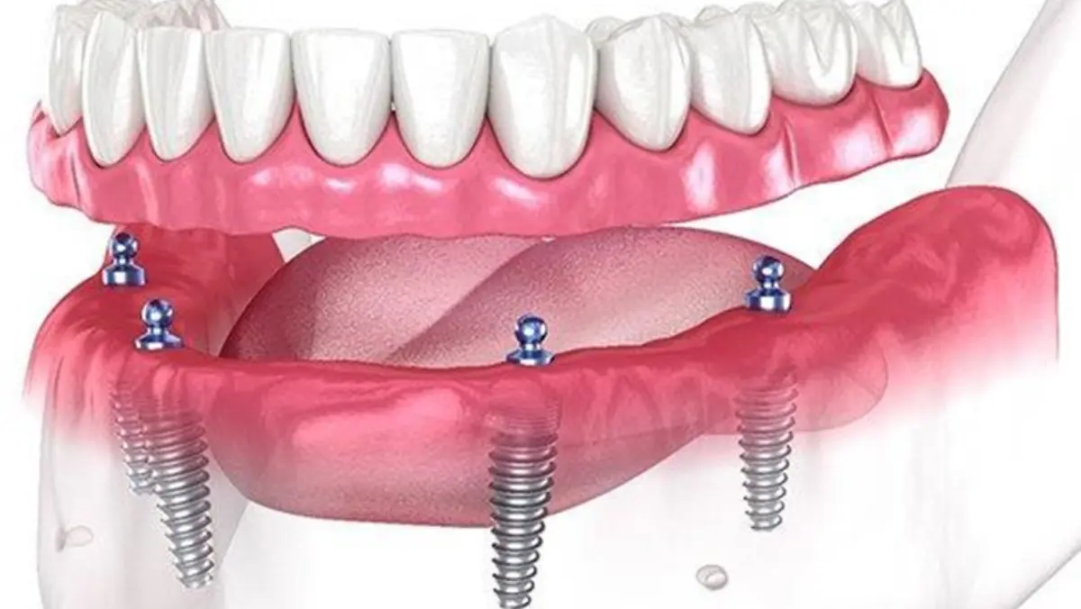 ALL ON 4/ 6 IMPLANTS