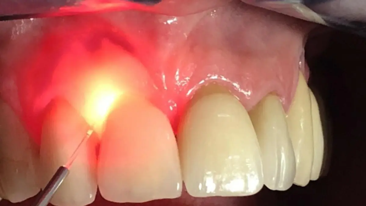 GINGIVAL DE PIGMENTATION