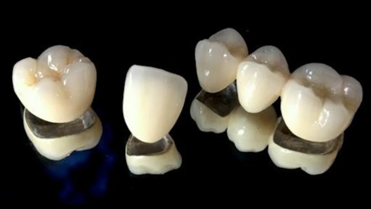 CROWNS AND BRIDGES - Ceramic Braces