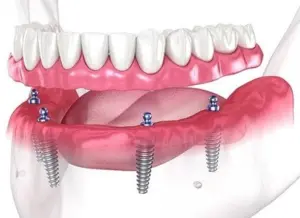 All on 4/ 6 Implants