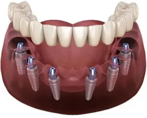 All on 4/ 6 Implants