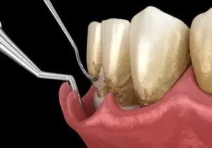 SUB GINGIVAL CURETTAGE