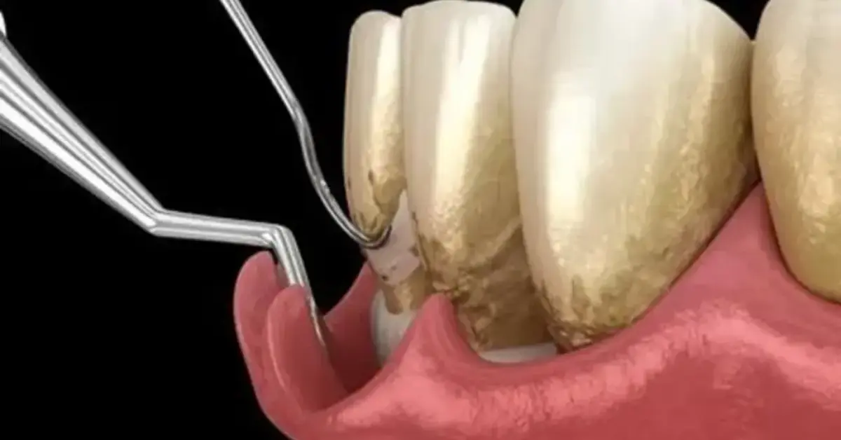 Sub Gingival Curretage