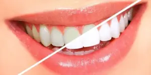 TEETH WHITENING/ BLEACHING