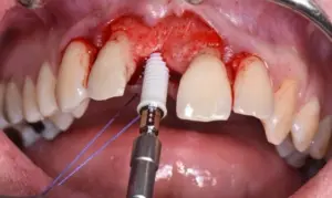Zirconia implants