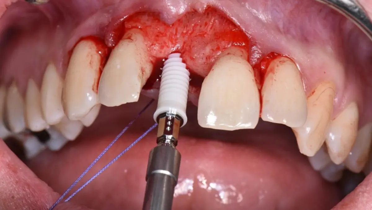 Zirconium implant