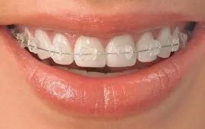 Ceramic Brace
