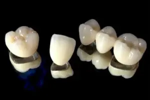 Ceramic Crowns