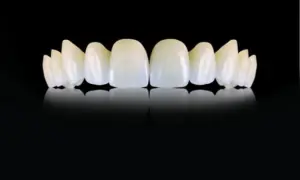 E max crowns