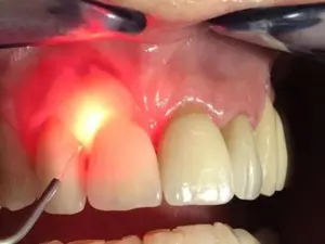 GINGIVAL DE PIGMENTATION