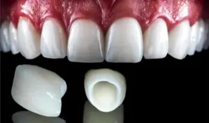 Zirconia Crowns