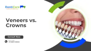 Veneers vs. Crowns