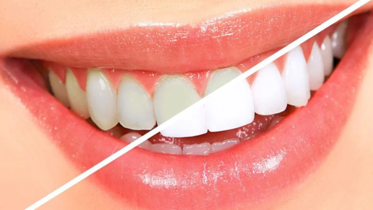 TEETH WHITENING/ BLEACHING