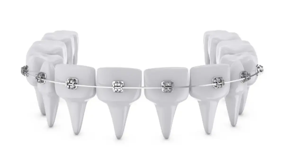 Orthodontics - Metal Brace
