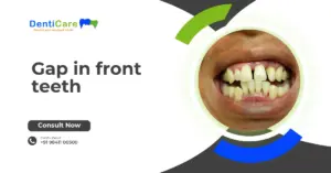 Chapter 12 - Gap in front teeth