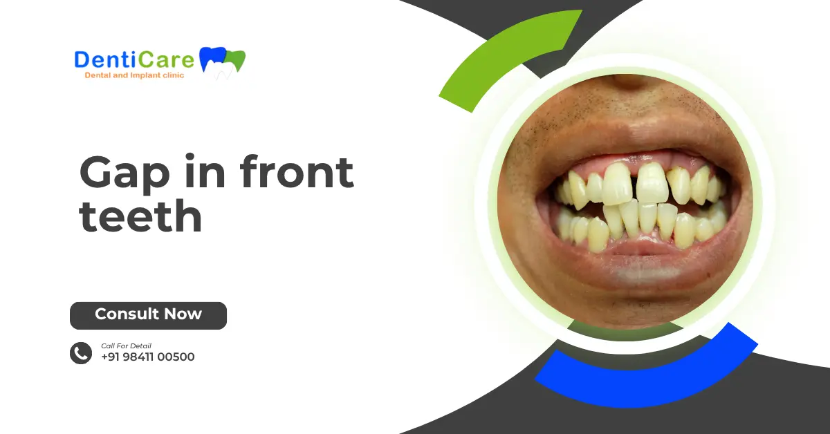 Chapter 12 - Gap in front teeth