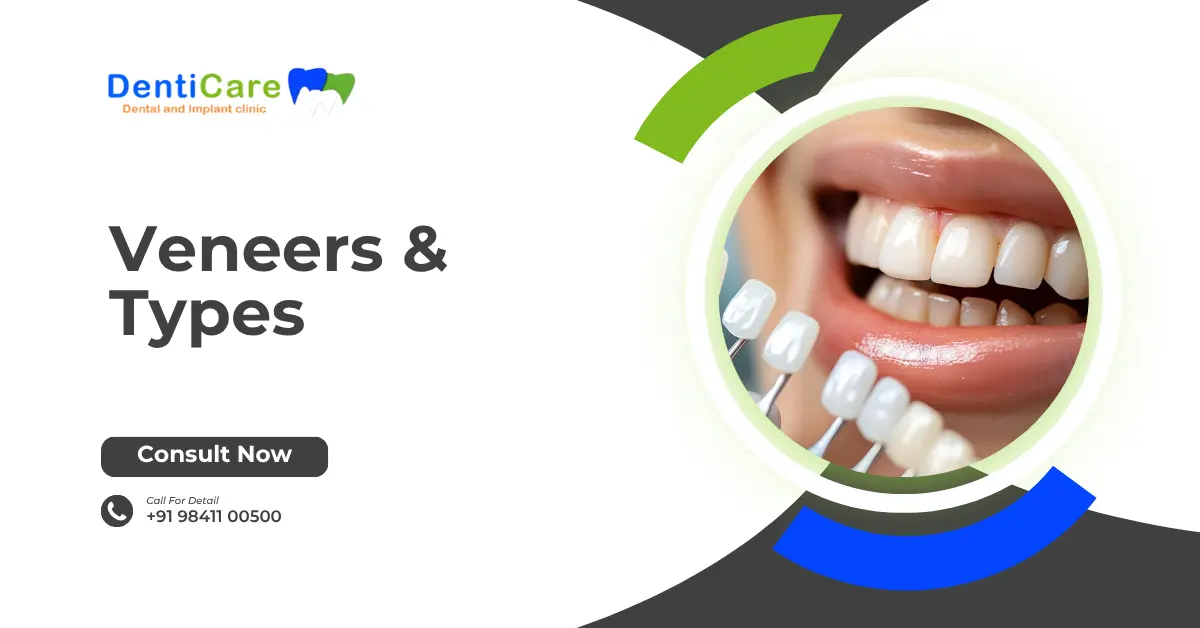 Chapter 13 - Veneers & Types