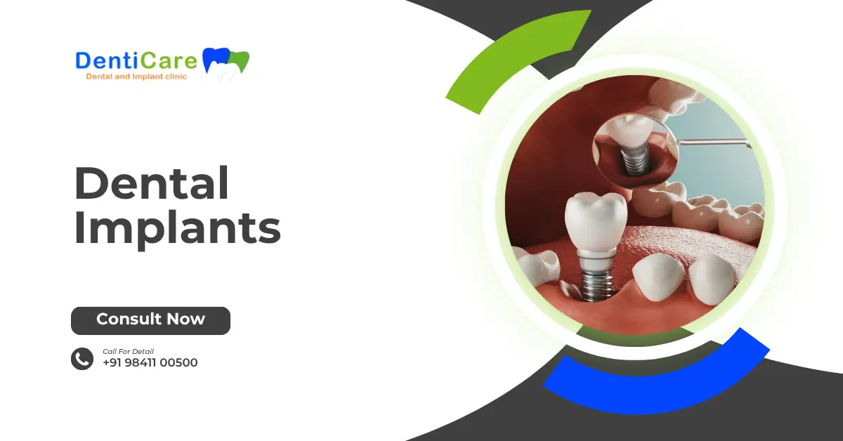 Chapter 16 - Dental Implants ( Part C)