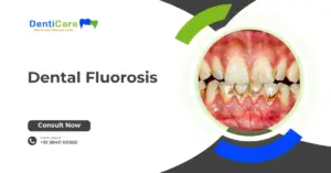 Chapter 20 - Dental Fluorosis