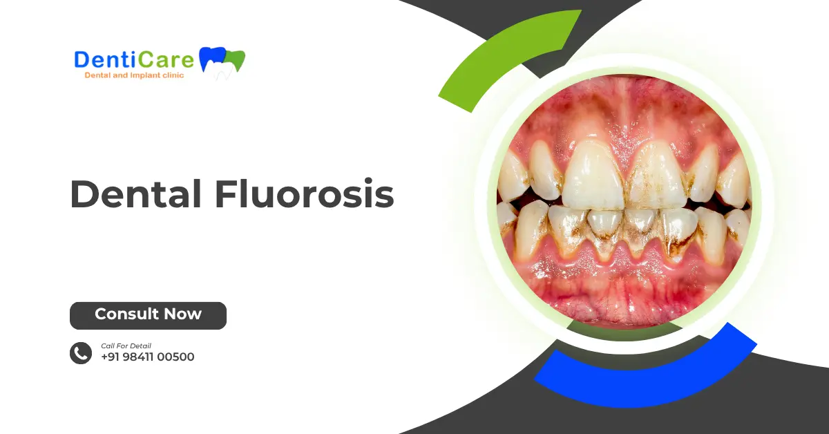 Chapter 20 - Dental Fluorosis