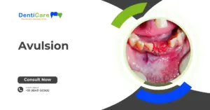 Chapter 17- Avulsion