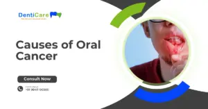 Causes of Oral Cancer
