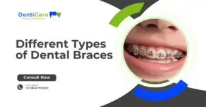 Different Types of Dental Braces